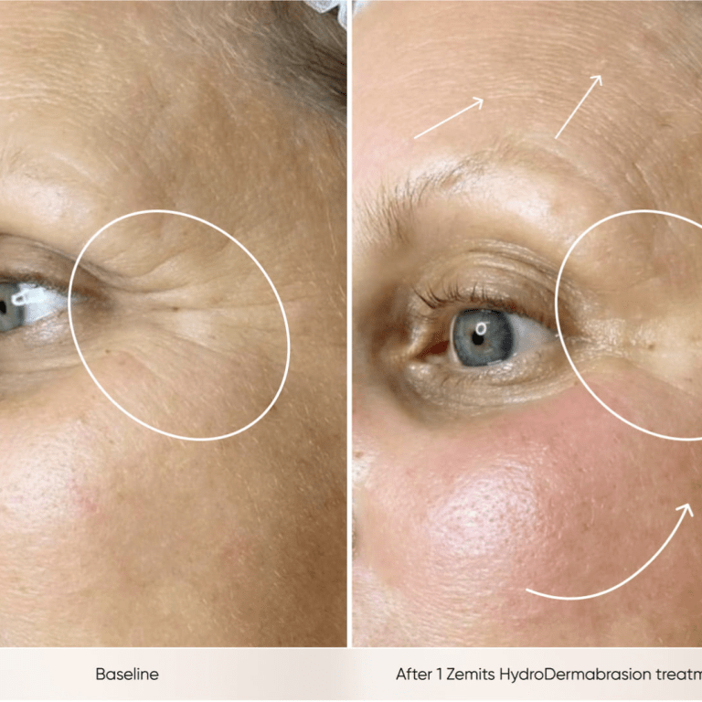 Anti-Aging Hydroglow facial