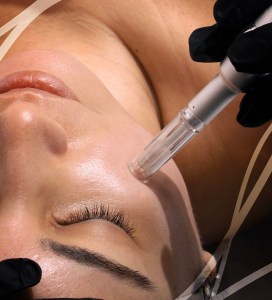 Epen Microneedling Vancouver