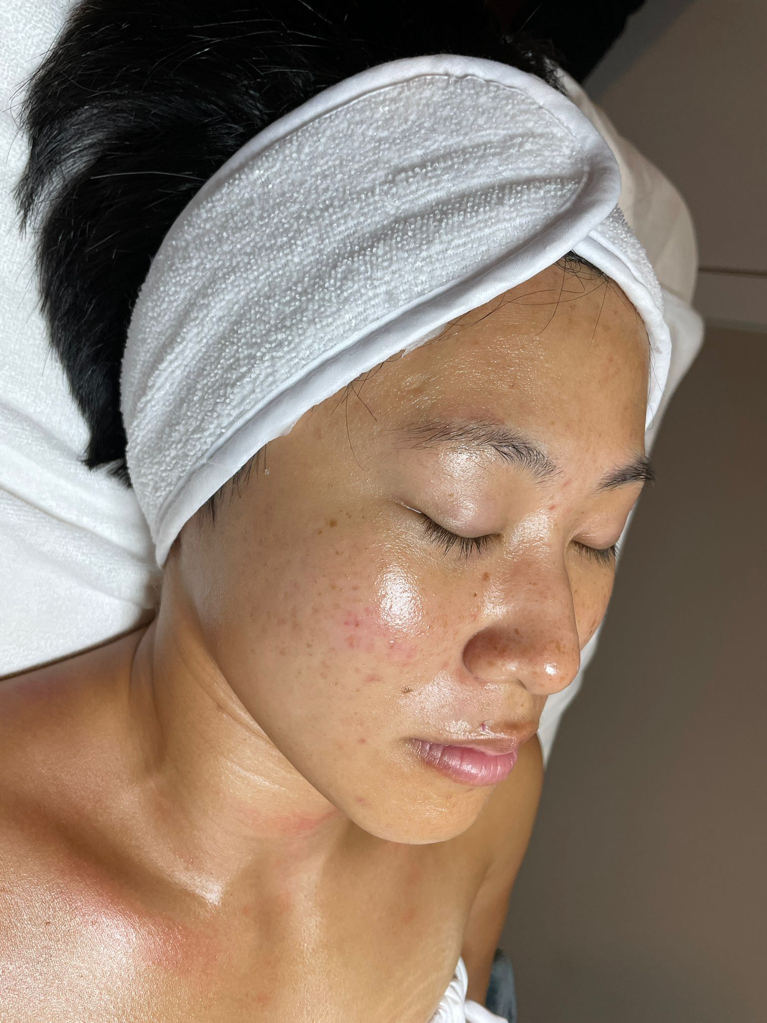 Hydroglow facial vancouver